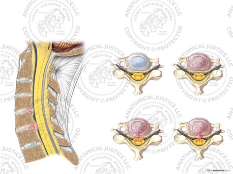 Cervical Degenerative Disc Disease With Central Disc Injuries No Text