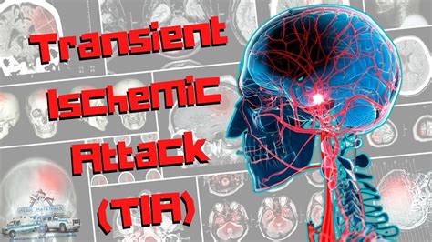 Is A Transient Ischemic Attack Tia A Stroke Causes Symptoms