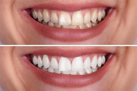 Teeth Whitening And How To Maintain Your White Teeth Excellence In