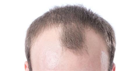 How To Stop Receding Hairline 9 Science Backed Tips To Follow