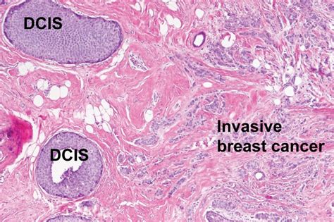 Forensic Techniques Enable Study Of Individual Breast Cancer Cells From