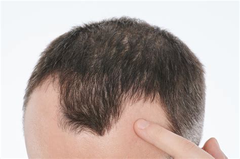 Could Nutrient Deficiencies Lead To Hair Loss Abundance And Health