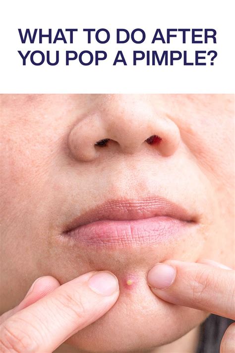 How To Heal A Popped Pimple