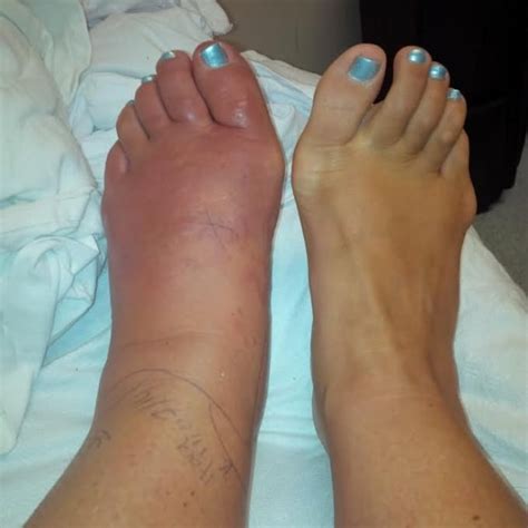 Woman Develops Potentially Life Threatening Infection After Pedicure In