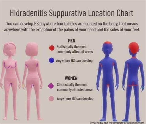 Hidradenitis Suppurativa Location Chart Awareness Meme Quote Hs