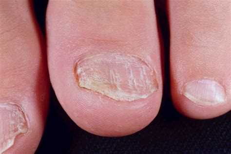 Psoriatic Fingernails Nail Psoriasis Nail Diseases Psoriasis Causes