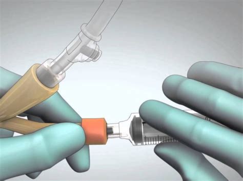 How To Remove A Catheter Catheter Supply Company