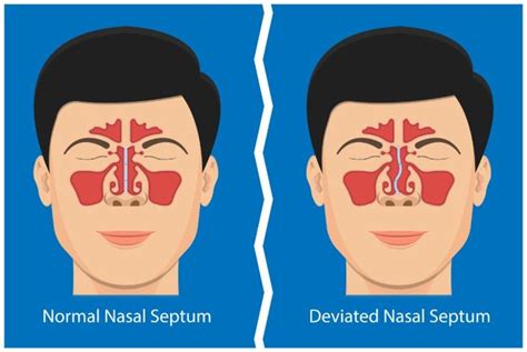 What Is A Deviated Septum Facty Health