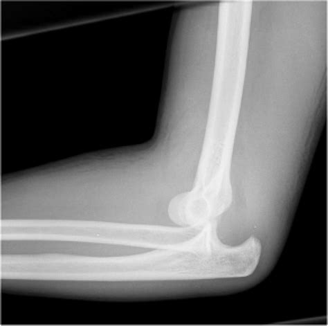 Dislocations Of The Elbow An Instructional Review Journal Of