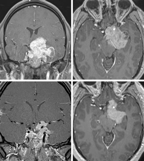 Diagnosing Pituitary Tumor Expert Surgeon Aaron Cohen Gadol Md