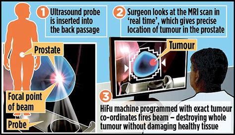 New Hope For Men With Early Prostate Cancer After Development Of New Ultrasound Daily Mail Online