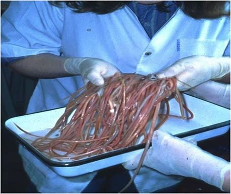 Symptoms Of Tapeworms In Humans Tapeworm Human Top Ten Most Disgusting Medical Therapies