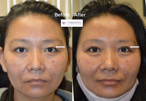 Before And After Asian Blepharoplasty Gallery Taban Md