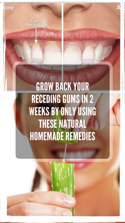 Grow Back Your Receding Gums In 2 Weeks By Only Using These Natural
