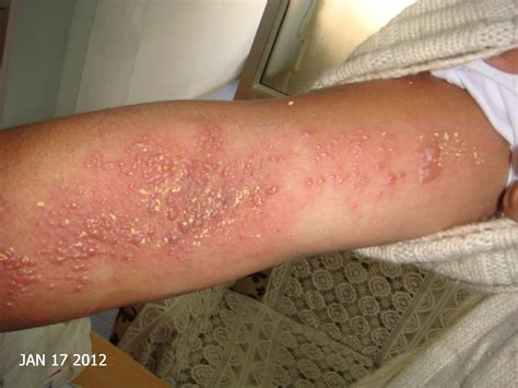 Herpes Zoster Treatment Homeopathy What Is Eczema Herpeticum Herpes