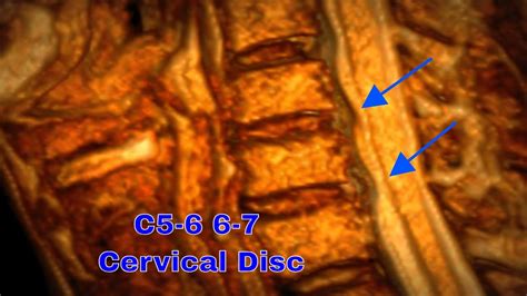 C5 6 6 7 Cervical Disc Herniation Youtube
