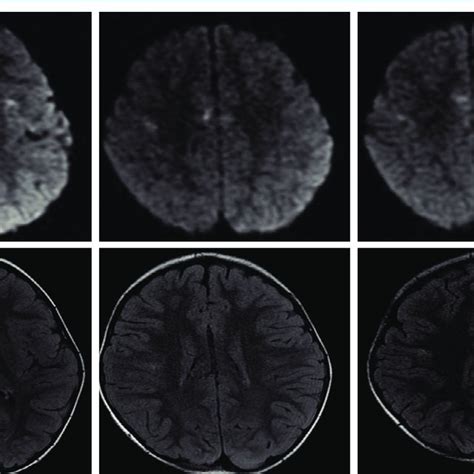 Electroencephalography A Initial Eeg Arrows Show Periodic Lateralized