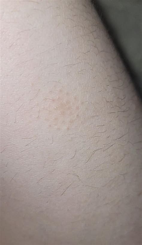 Random Patch Of Non Itchy Bumps On My Skin All Localized To This One