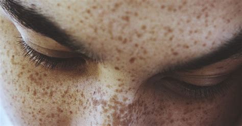 How To Get Rid Of Freckles 7 Ways