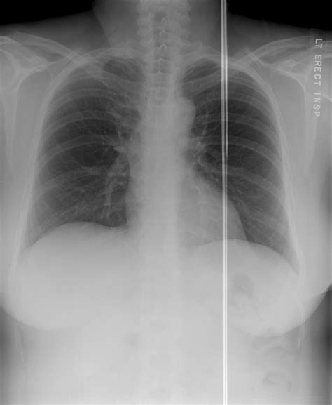 Morie Artifact Mri