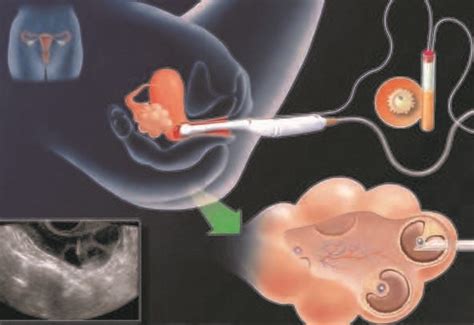 vancouver in vitro fertilization ivf clinic pcrm vancouver fertility clinic