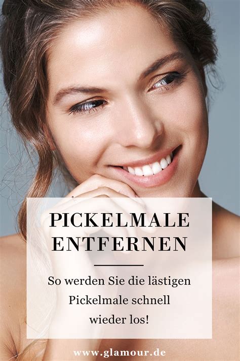 Powerful uv load increases the risk of getting melasms. Pickelmale entfernen - So geht's richtig! | Pickel ...