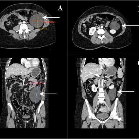 Large Retroperitoneal Cystic Mass Axial And Coronal View Of Abdominal
