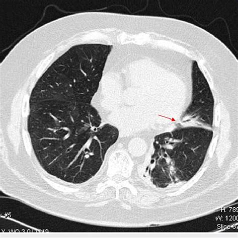 Ct Scan Of The Thorax Showing The Focal Area Of Consolidation Red