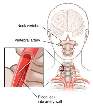 Best Vertebral Artery Dissection Images Vertebral Artery Arteries My