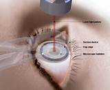 Laser Treatment For Eyes Advantages And Disadvantages Images