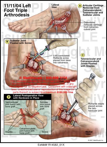 Left Foot Triple Arthrodesis Medivisuals Medical Illustration