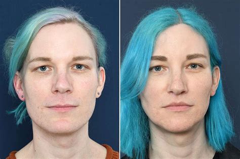 Facial Feminization Enhancements Telegraph