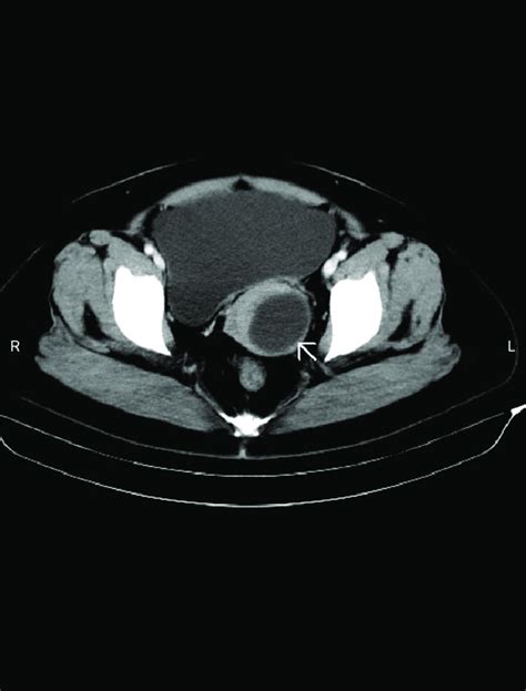 Pelvic Computed Tomography Scan Showing An Enlarged And Distended