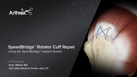 Arthrex Speedbridge Rotator Cuff Repair Using The Speedbridge