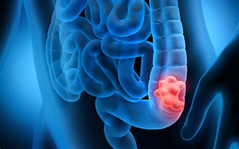 Advanced bowel cancer is cancer that started in either the back passage (rectum) or large bowel (colon) and has spread to another part of the body. All You Should Know About The Signs And Symptoms Of Colon ...