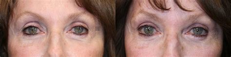 Patient 75528660 Wrinkle Relaxer Before And After Clinic 5c