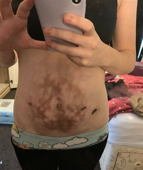 Mums Endometriosis So Severe Shed Burn Herself With Hot Water Bottle