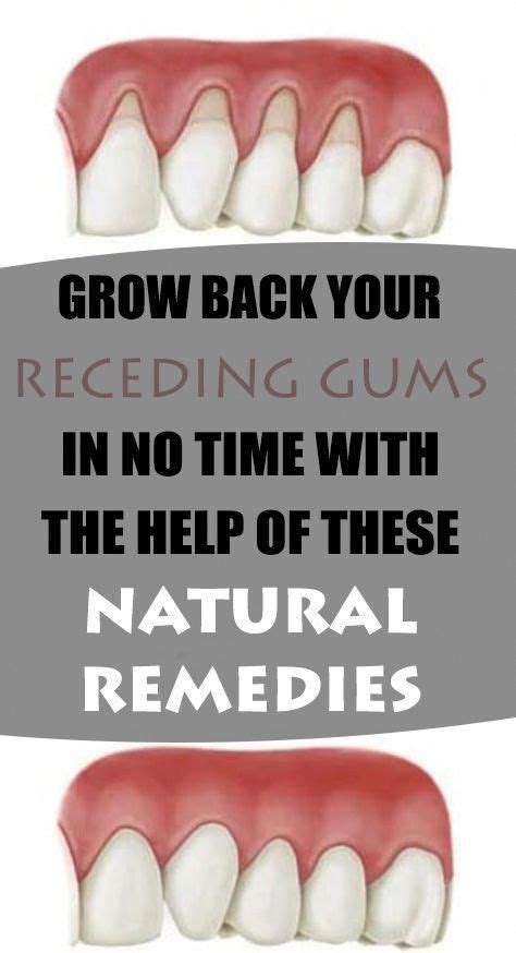 Grow Back Your Receding Gums In No Time With The Help Of These Natural