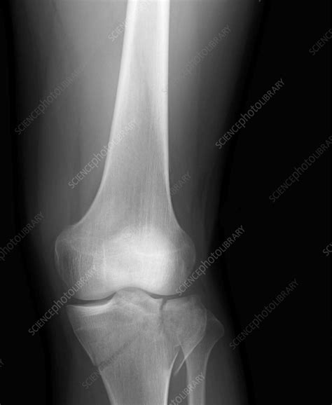 Tibial Plateau Fracture X Ray Stock Image F0360263 Science