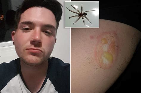 Spider Leaves Man With Flesh Eating Wound That Wont Heal