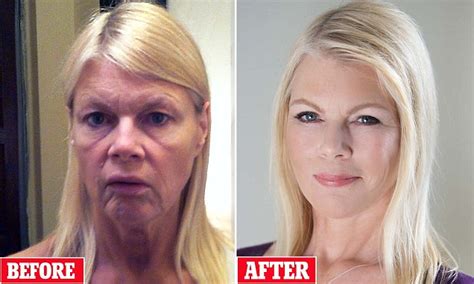 Karen Hogan Left With Sagging Skin After Weight Loss Undergoes A Face