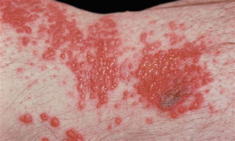 There are two types of hsv that can cause a skin rash in different areas: Conditions Related to HIV/AIDS