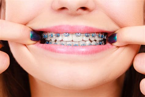 Types Of Dental Braces Explained Tooth Doctor
