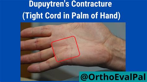 Dupuytrens Contracture Tight Cord In Palm Of Hand Youtube