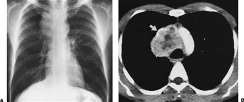 Mediastinum Thoracic Key