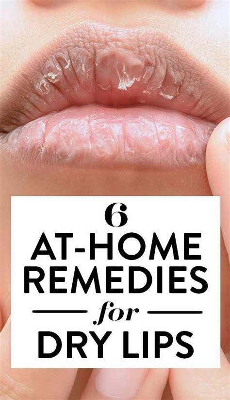 At Home Remedies For Dry Lips Remedies For Chapped Lips Dry Lips
