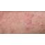 Consensus Statement Outlines New Pathway For Adult Eczema