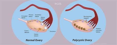 Possible Treatment For Polycystic Ovary Syndrome Pcos Concept Fertility