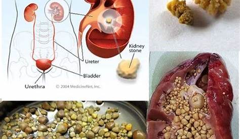 Who Is More Likely To Get Kidney Stones - HealthyKidneyClub.com