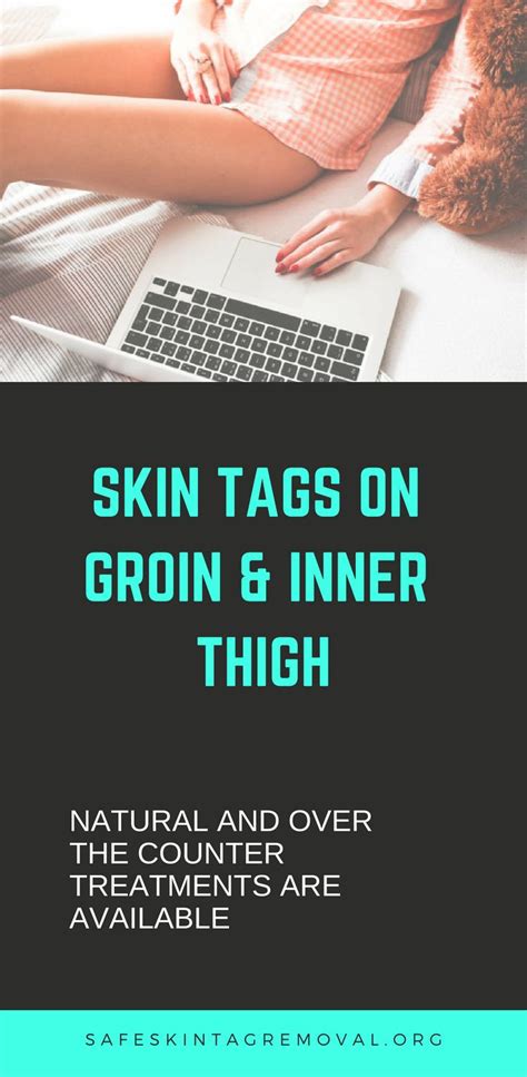 Eliminate Skin Tags On Groin And Inner Thigh Today Skin Tag Removal In